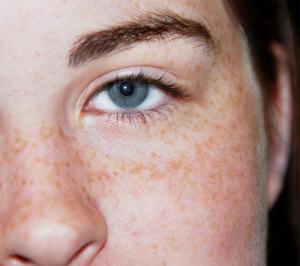 freckles on eyeballs