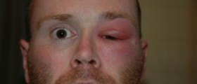 About facial cellulitis