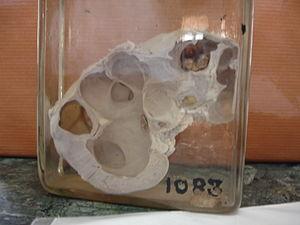 About hydronephrosis facts