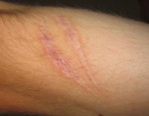 About hypertrophic scarring