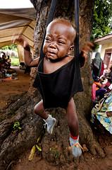 About Malnutrition symptoms
