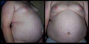 About obesity treatment