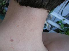 About skin exfoliation