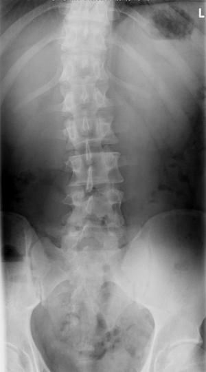 About the scoliosis