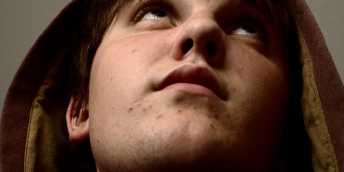 Natural Remedies For Acne: What's New, What Works