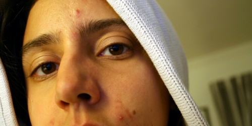 Acne: What Works and What not?