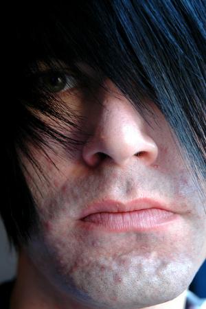 Acne cure : it does exist !
