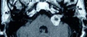 Acoustic neuroma: Vestibular schwannoma symptoms