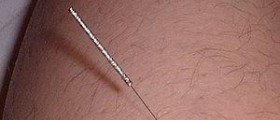 Acupressure the new cure for acid reflux ?