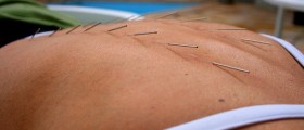 Acupuncture And Pain Relief