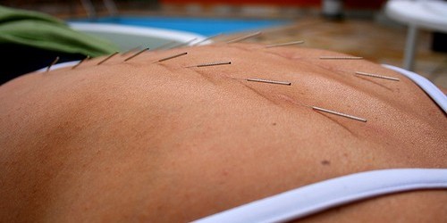 Acupuncture And Pain Relief