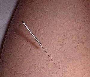 Acupuncture can help you with migraine headaches