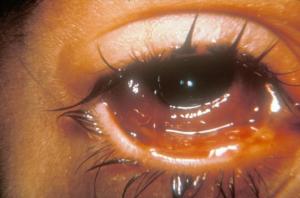Acute bacterial conjunctivitis