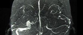 Acute behavioural disorder