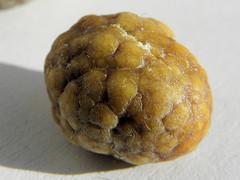 Acute biliary colic