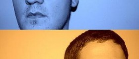 Acute bipolar disorder