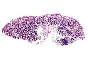 Acute bowel obstruction