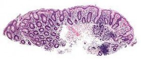 Acute bowel obstruction
