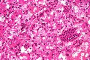 Acute cerebellar ataxia