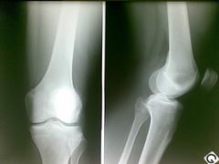 Acute cruciate ligament