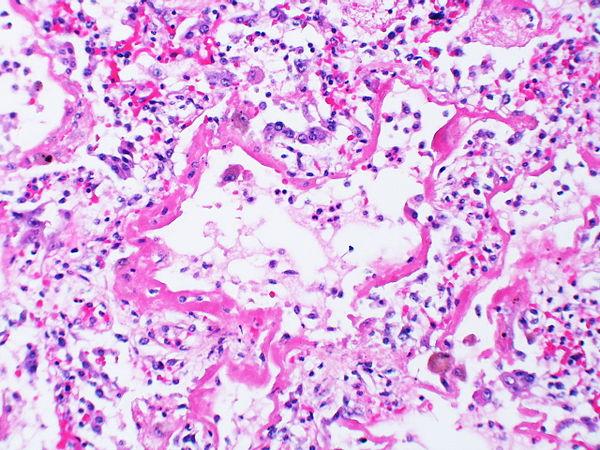 Acute cutaneous lupus