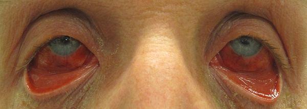 Acute gout treatment
