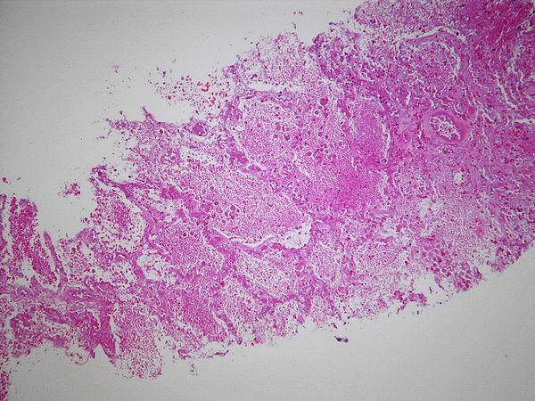 Acute porphyria symptoms