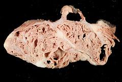Acute renal failure causes