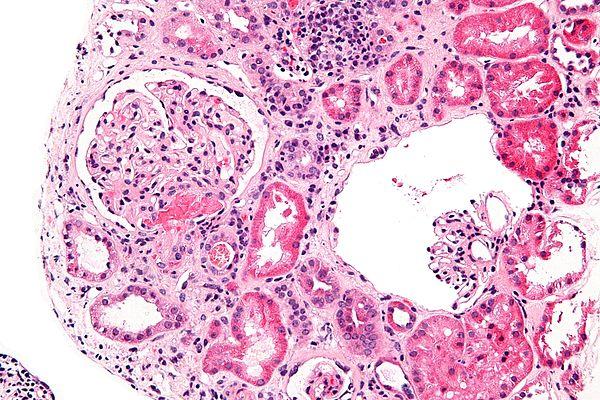 Acute telogen effluvium