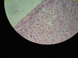 Adrenal gland disorders in women