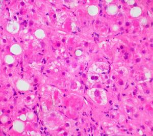 Alcoholic fatty liver