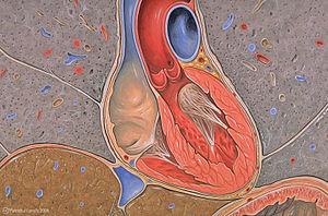 All about ischemic cardiomyopathy