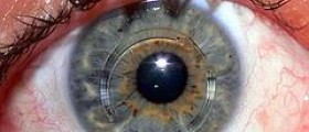 All about keratoconus