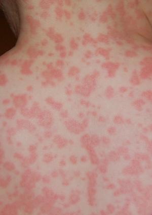 Allergic reaction to amoxicillin
