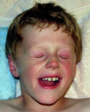 Allergies in winter