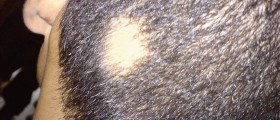 Alopecia areata