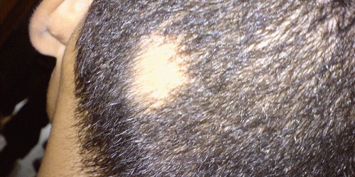 Alopecia areata
