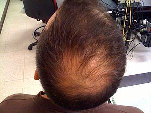 Alopecia areata treatment