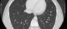 Alternative therapy for lung cancer