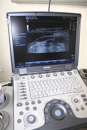 Amniocentesis for prenatal diagnosis