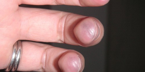 Study: Iron Deficiency Anemia Increases The Risk Of Stroke