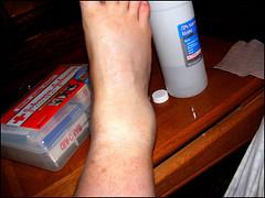 Ankle pain at night