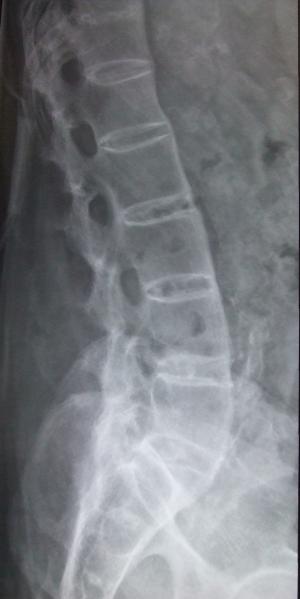 Ankylosing spondylitis treatments