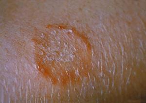 Antifungal for ringworm