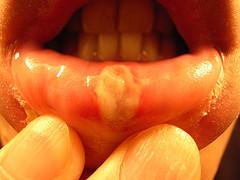 Aphthous ulcers - Canker sores