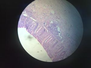 Appendicitis surgery guidelines