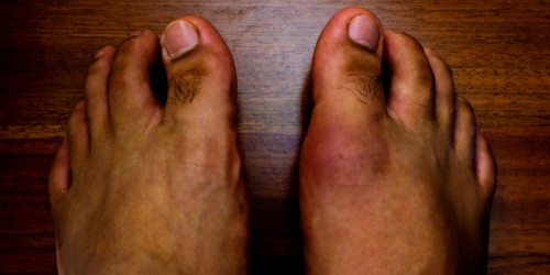 What Should You Know About Reactive Arthritis?