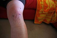 Arthroscopic knee surgery