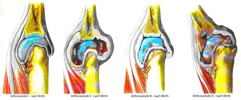 Arthroscopic knee surgery recovery