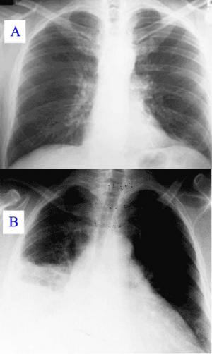Atypical pneumonia facts